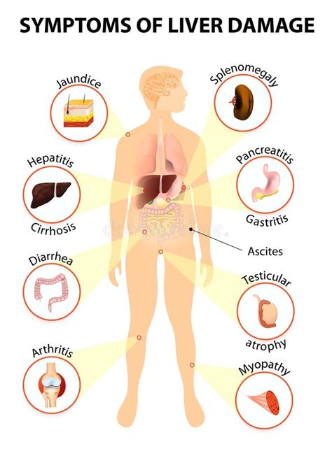 Symptoms Of Liver Disease stock vector. Illustration of care - 53960303