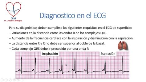 Arritmia sinusal respiratoria - YouTube