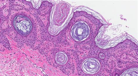 Seborrheic keratosis | MyPathologyReport.ca