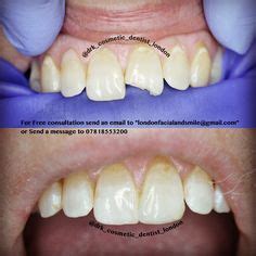 25 Smile design types ideas | smile design, cosmetic dentistry, dentistry