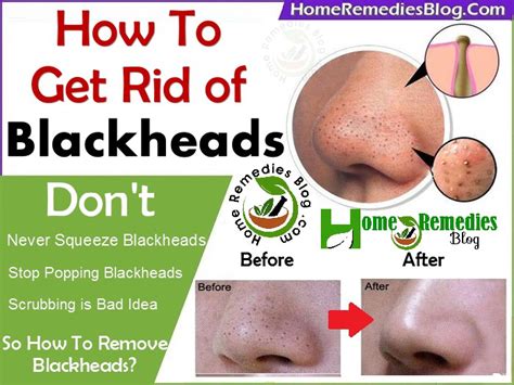 How to Get Rid of Blackheads Using Home Remedies - Home Remedies Blog