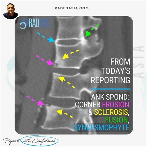 A FEW SPINAL CHANGES IN ANKYLOSING SPONDYLITIS - Radedasia