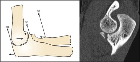 Contribution of coronoid process in elbow stability (First part of this ...