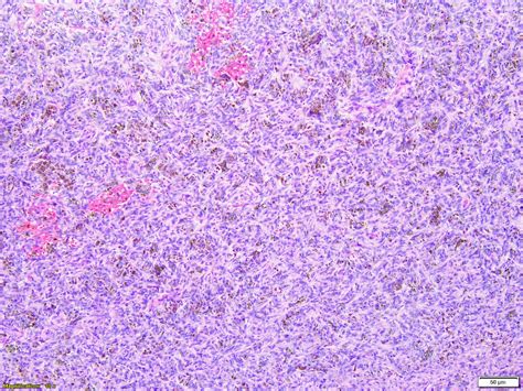 Benign Fibrous Histiocytoma