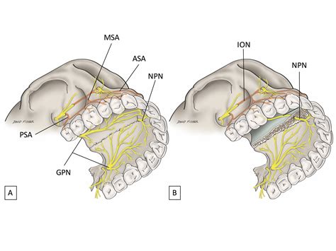 Cureus | Palatal Injection does not Block the Superior Alveolar Nerve ...