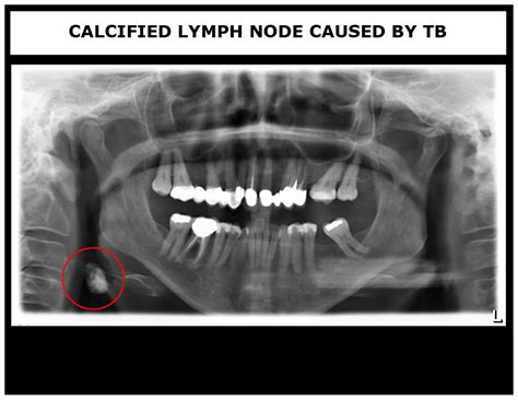 X-Ray Pathology | My Family Dentist