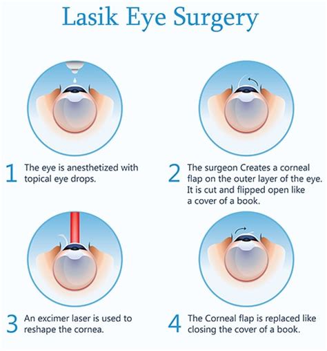 Subtropical nefolosit Câştiga laser eye surgery risks guvernabilă aparat Ciuguli