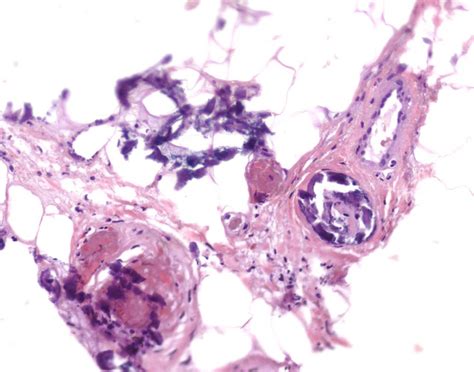 Calciphylaxis (Calcific uremic arteriolopathy) - Dermatology Advisor