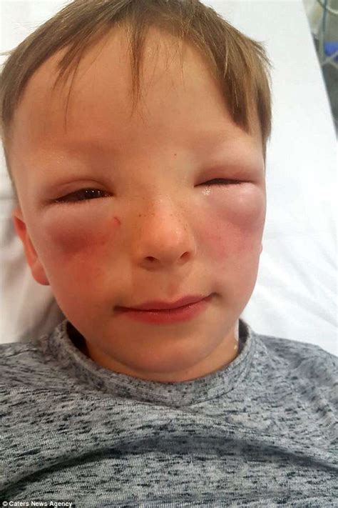 Schoolboy, 7, with severe hay fever saw his face TREBLE in size - Take the Health