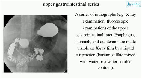 upper gastrointestinal series - YouTube