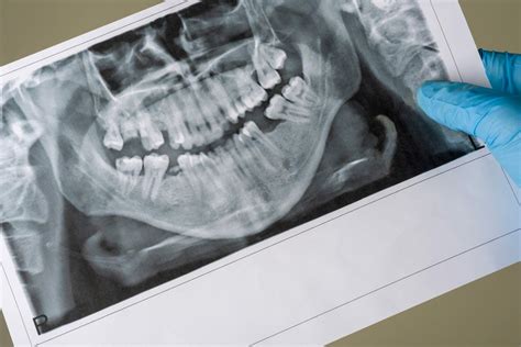 Can dental bone loss be reversed? ENAMEL REPUBLIC