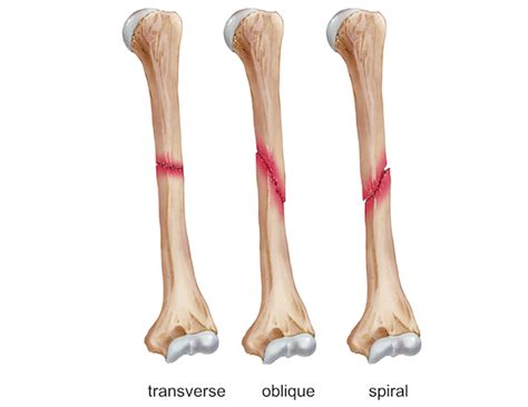 Classification Of Humerus Fractures