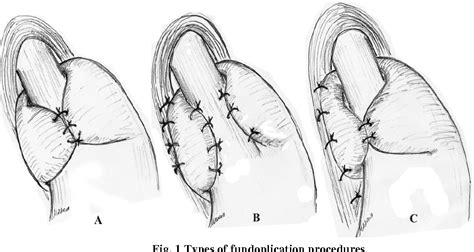 Nissen Fundoplication