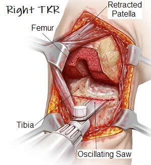 Knee Replacement Surgery Video: What Happens - Knee Pain Explained