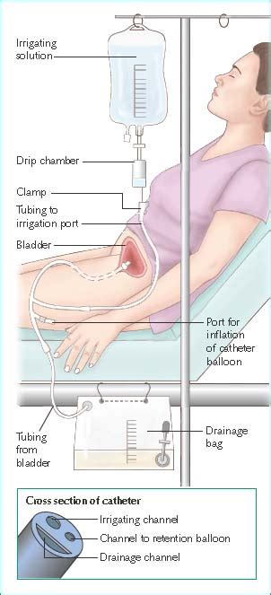 Continuous Bladder Irrigation | Nurse Key