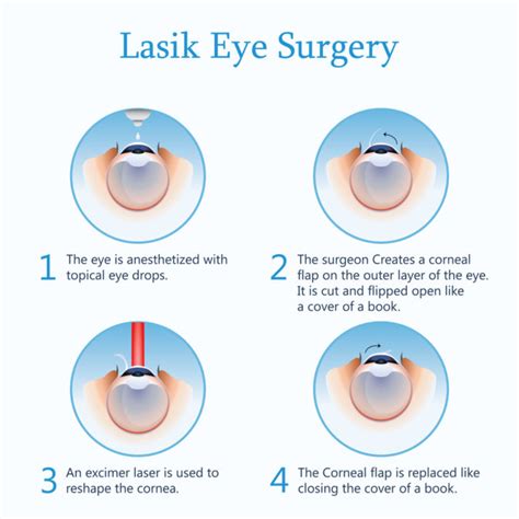 LASIK Procedure: How Does LASIK Work | Eye Pain Center