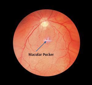 Macular Pucker St. Leonards | Detached Retina | Eye Surgery North Shore