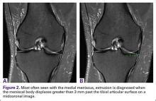 Meniscal Root Tears: Identification and Repair | MDedge Surgery