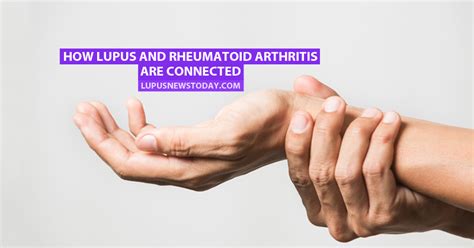 How Lupus and Rheumatoid Arthritis Are Connected - Lupus News Today