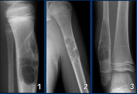 The Radiology Assistant : Bone tumors (2022)