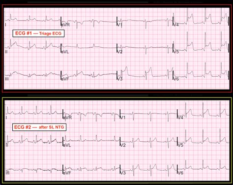 Dr. Smith's ECG Blog: Is this a STEMI? No, not by definition! Why not ...