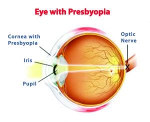 Presbyopia Causes, Symptoms and Treatments | New Health Advisor