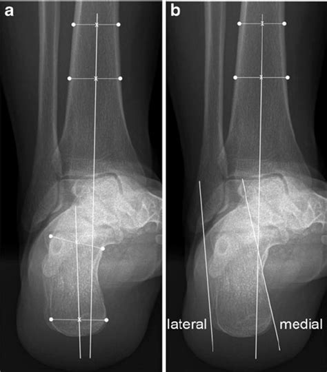 Measurement of hindfoot alignment on hindfoot alignment radiographs ...