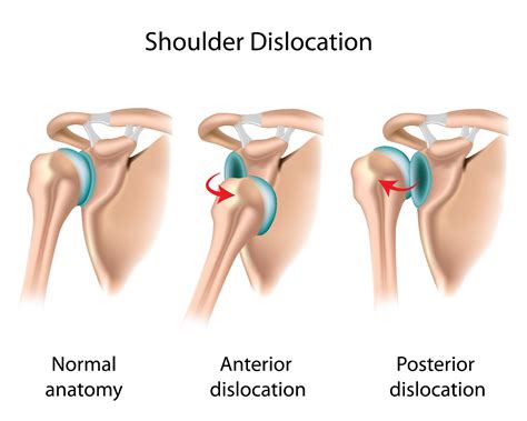 Treating Your Shoulder Dislocation and Preventing it in the Future | Performance Health