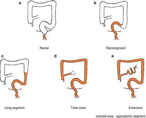 Hirschsprung's disease - PSIONJournal