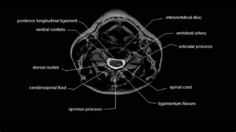 Cervical Spine MRI Axial View