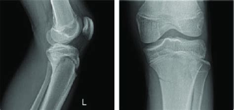 The AP & Lateral Knee X-Ray shows fracture line. | Download Scientific Diagram