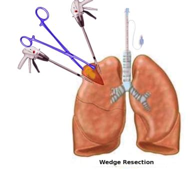 Surgical Resection