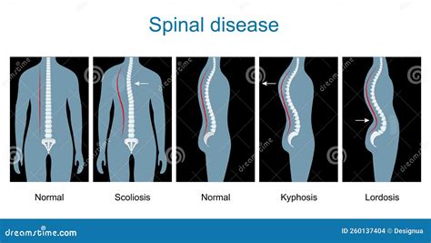 Normal Spine and Spinal Deformity from Scoliosis To Lordosis and Kyphosis Stock Vector ...