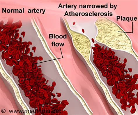 Atherosclerosis Symptoms | medica-ad.co.jp