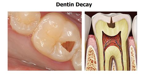 The 5 Stages of Tooth Decay | News | Dentagama