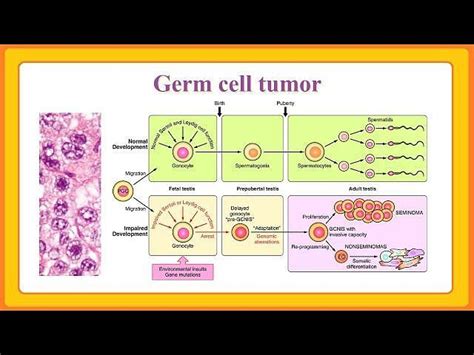 What is Germ Cell cancer? Symptoms and more explored as Tim Roth's son ...