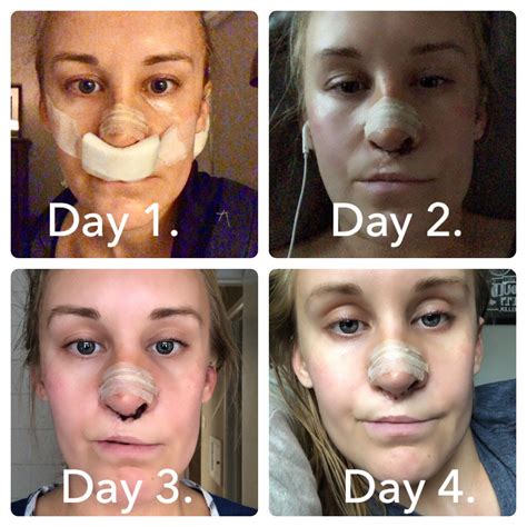 Rhinoplasty revision day 4 update. Hit peak swelling on day 3 and I ...