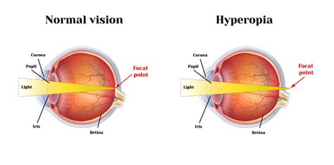 Hyperopia Diagram