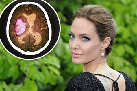 Angelina Jolie reveals she has Bell’s palsy – here are the signs to ...