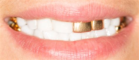 Silver Or Gold Dental Crown And Bridges - Amazing Smiles