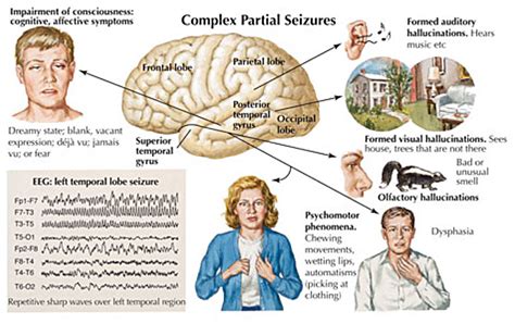 What is Epilepsy?