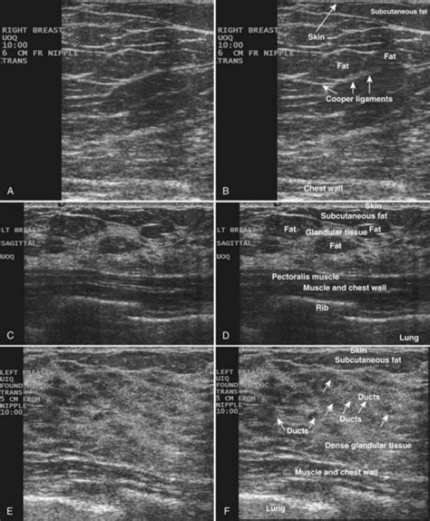 Breast Ultrasound | Radiology Key