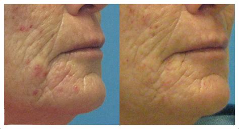 Micro Laser Peel | Dermatology Realm | Skin Care Memphis