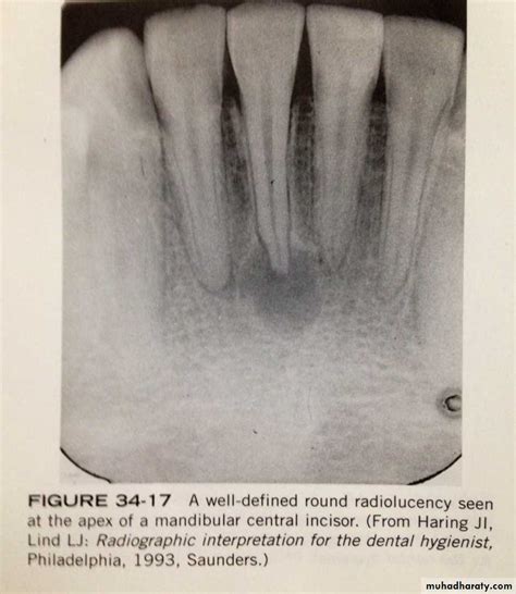 Periapical Abscess Ppt