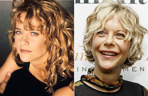 Hollywood Celebrity Meg Ryan before and after surgery photos