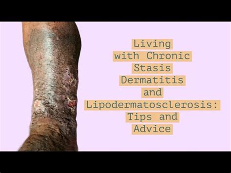 Living with Chronic Stasis Dermatitis and Lipodermatosclerosis: Tips and Advice - YouTube