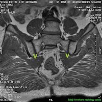 Dr Balaji Anvekar's Neuroradiology Cases: Pyriformis syndrome MRI