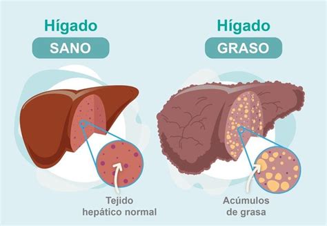 Encuentran un fármaco prometedor para el tratamiento del hígado graso no alcohólico | ASSCAT