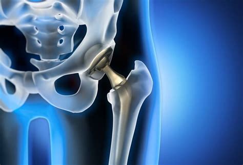 Stryker Hip Replacement Issues? Explore Remedies