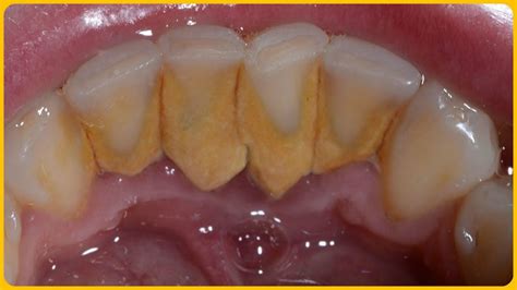 Get Rid Of Tartar and Plaque Using Only 2 Ingredients | Deep teeth ...